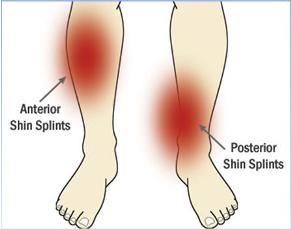 Shin-splints image