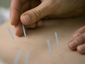 Barbican Acupuncture image