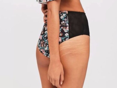 missguided stretchmarks featured